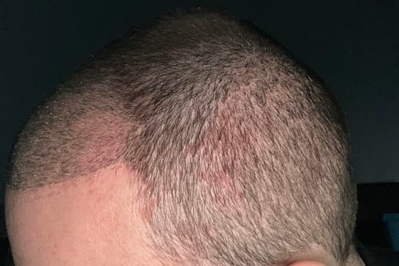 Managing Sensitivity, Redness, and Donor Area Discomfort