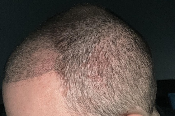 Managing Sensitivity, Redness, and Donor Area Discomfort